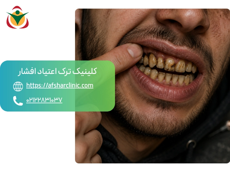 تأثیر هروئین بر رنگ دندان ها و مینای دندان